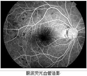 荧光血管造影:对达到或超过中度非增生性糖尿病视网膜病变者应进行